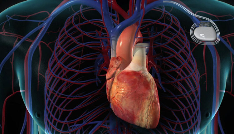 دل کے مریضوں کیلئے اچھی خبر، جسم میں جذب ہونے والا پیس میکر تیار